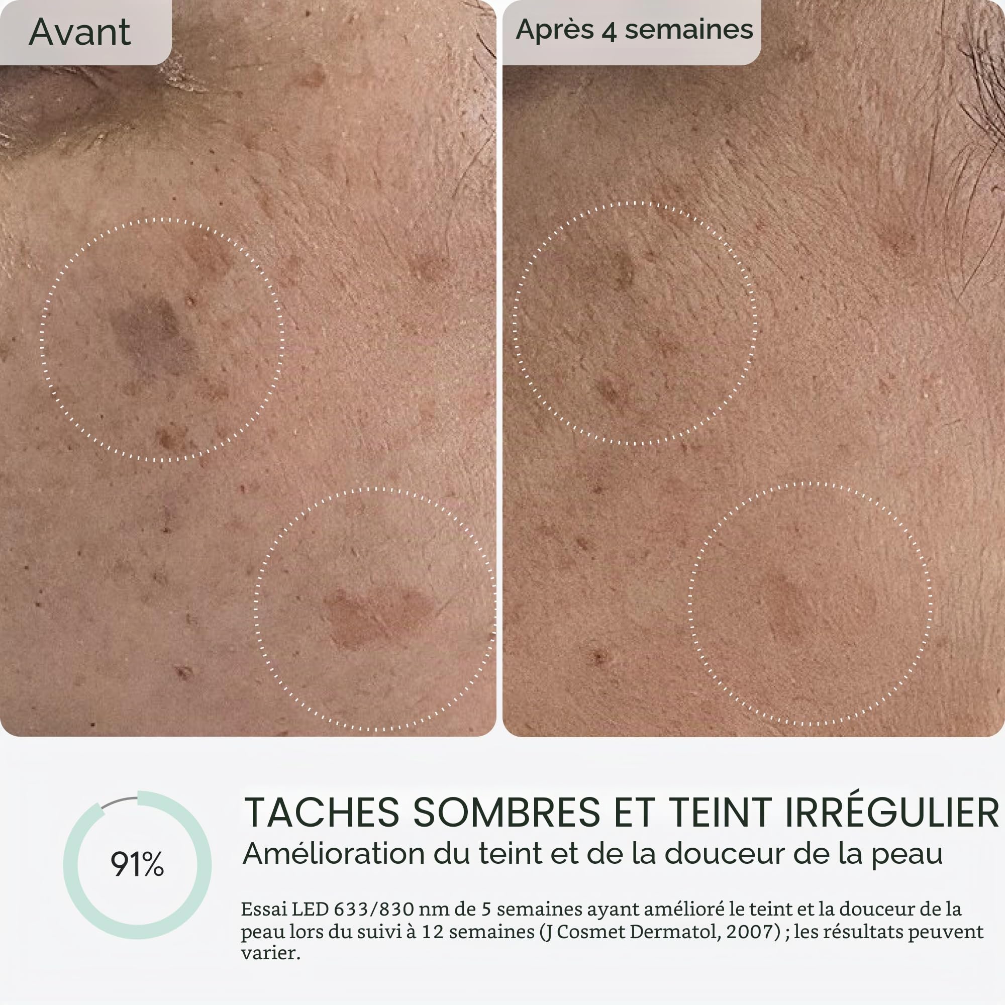 Qure Masque de soin de la peau LED avec 5 modes différents (thérapie par lumière rouge, lumière ambre et thérapie par lumière bleue) Un appareil avec paramètres et traitements personnalisables.