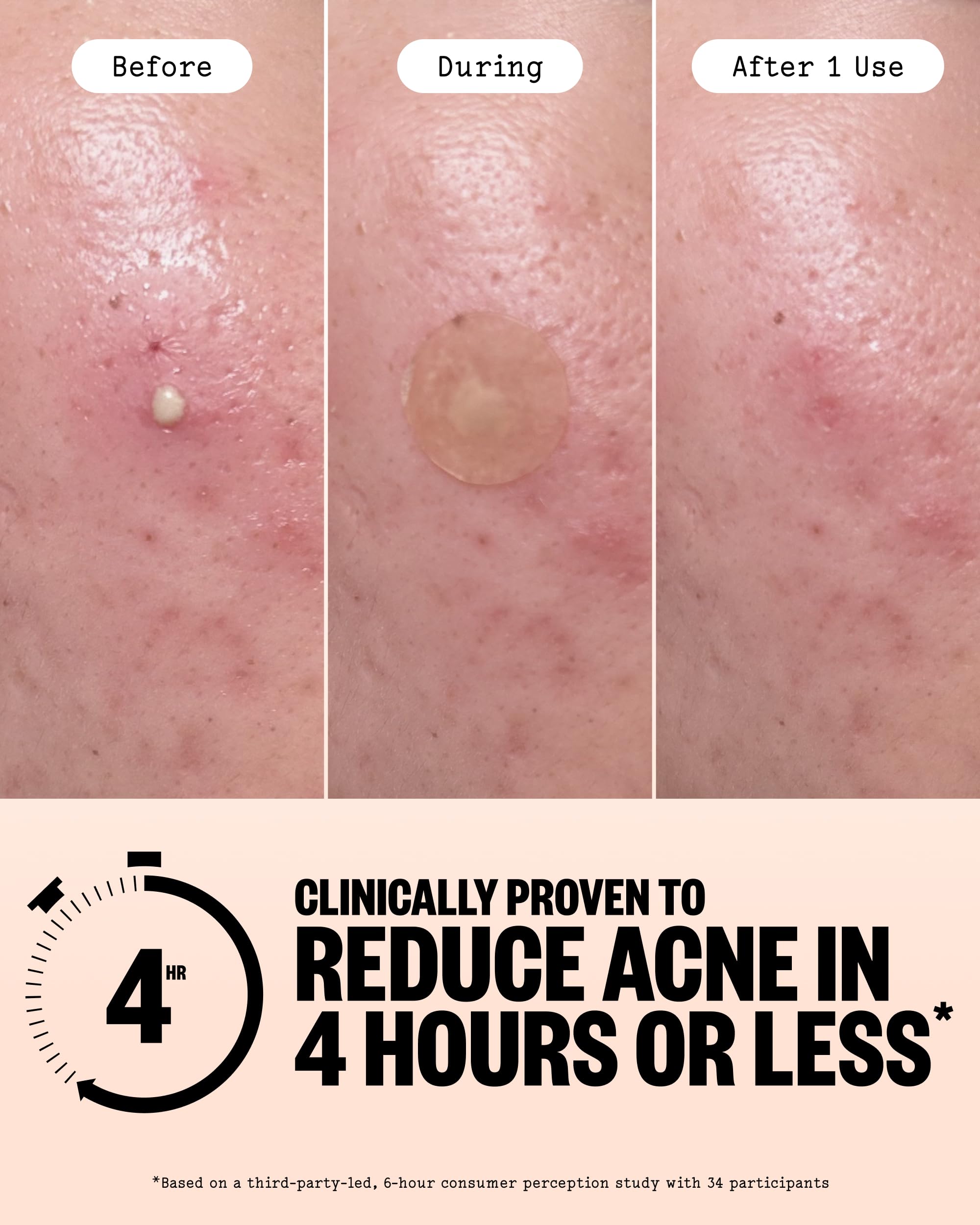 PEACE OUT Parches hidrocoloides para curar el acné, tratamiento de manchas de acné con ácido salicílico, retinol y aloe vera para imperfecciones y brotes (40 unidades)
