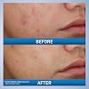 CeraVe Limpiador Espumoso para el Acné, Limpiador Facial con Peróxido de Benzoilo al 10%, 5oz | Limpiador con Peróxido de Benzoilo al 10% con Ácido Hialurónico y Niacinamida Elimina los Granos y Actúa como Eliminador de Puntos Negros 5 Fl Oz (Paquete de 1) 5