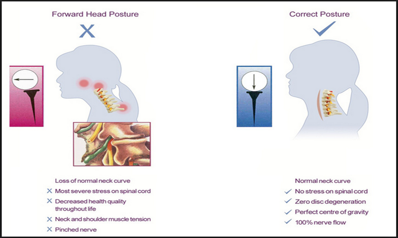 3 Ways to Correct Forward Head Posture - Aplicativo na Amazon Appstore