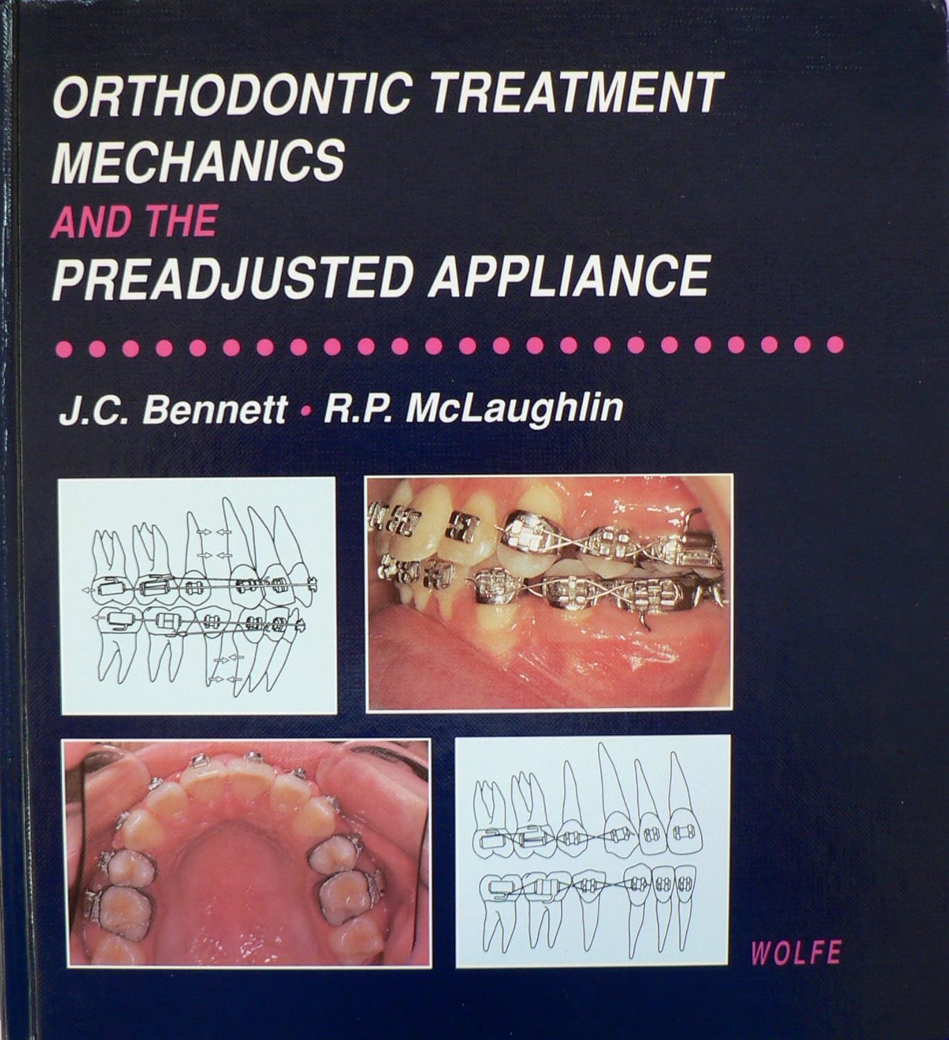 Orthodontic Treatment Mechanics and the Preadjusted Appliance John C
