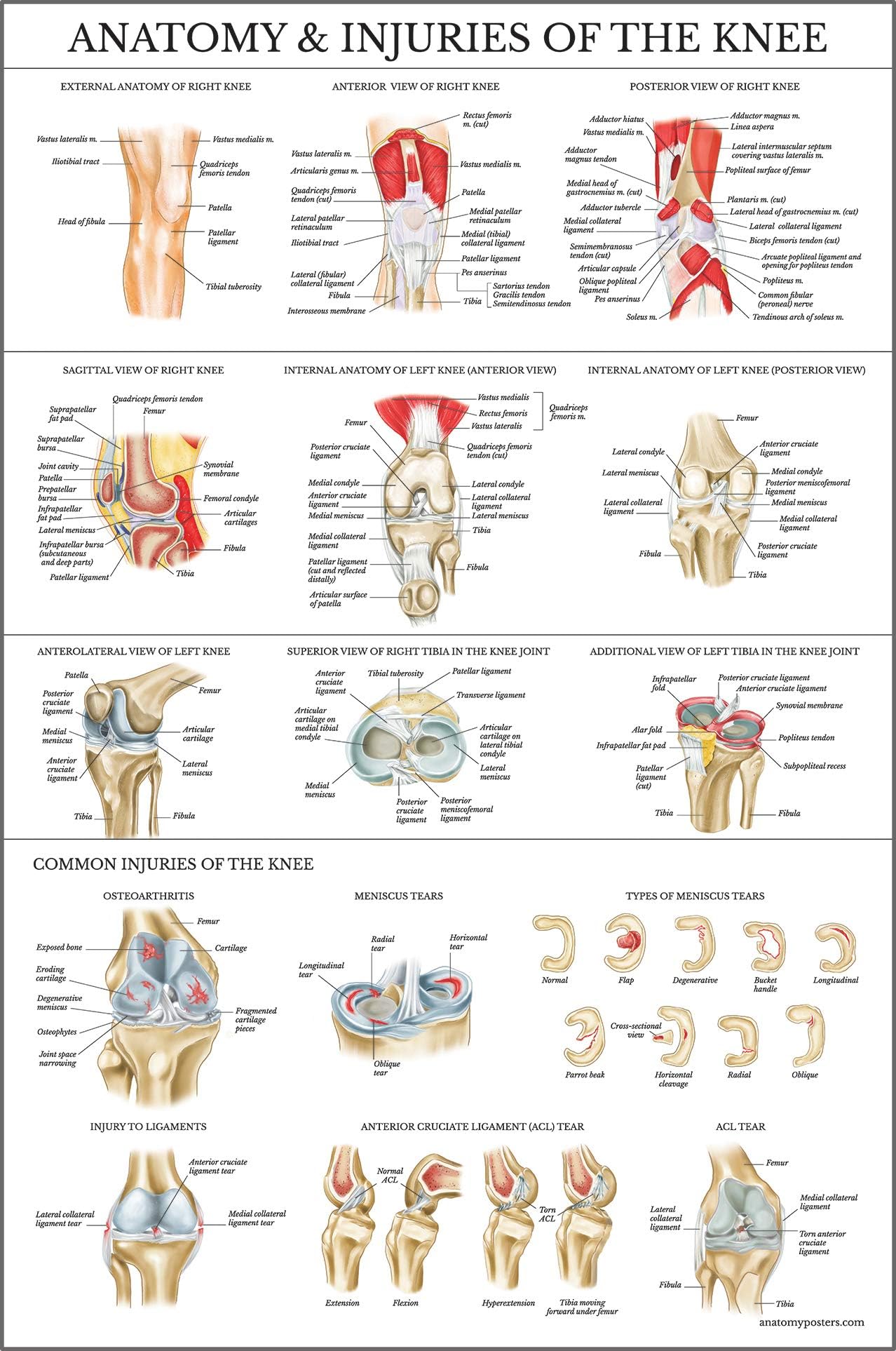 Palace Learning Laminated Anatomy and Injuries of the Knee Poster - Knee Joint Anatomical Chart - 18" x 24"