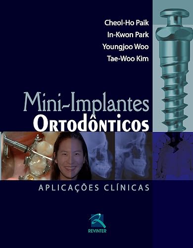 Mini-Implantes Ortodônticos: Aplicações Clínicas