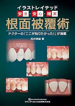 イラストレイテッド 安全・安心・確実 根面被覆術 (イラストレイ