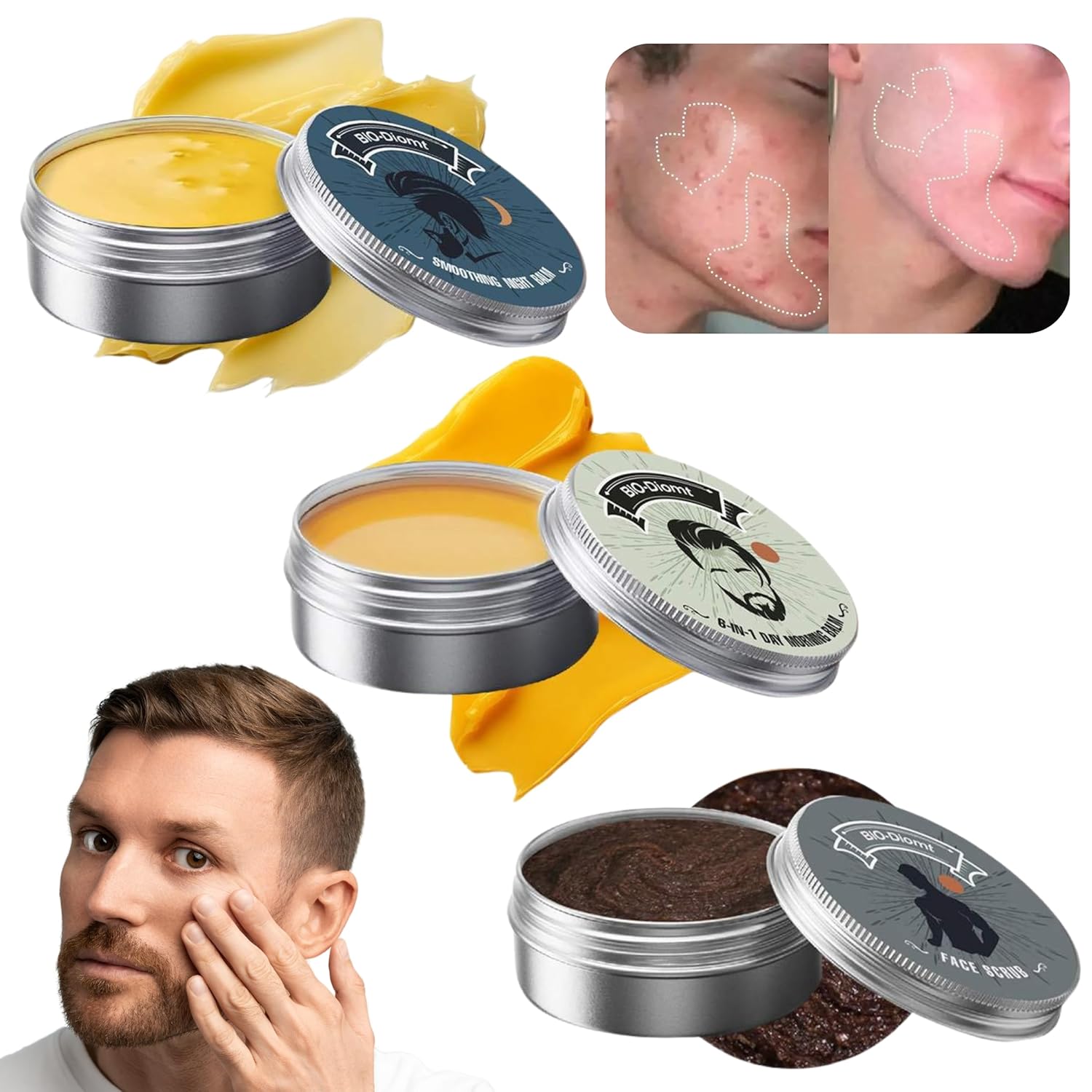 3Pcs Organic Acne and Redness Relief Balm, Organic Acne & Redness Killer, Clearing Cream, Acne Balm, Remove Skin Care Set for All Skin Types