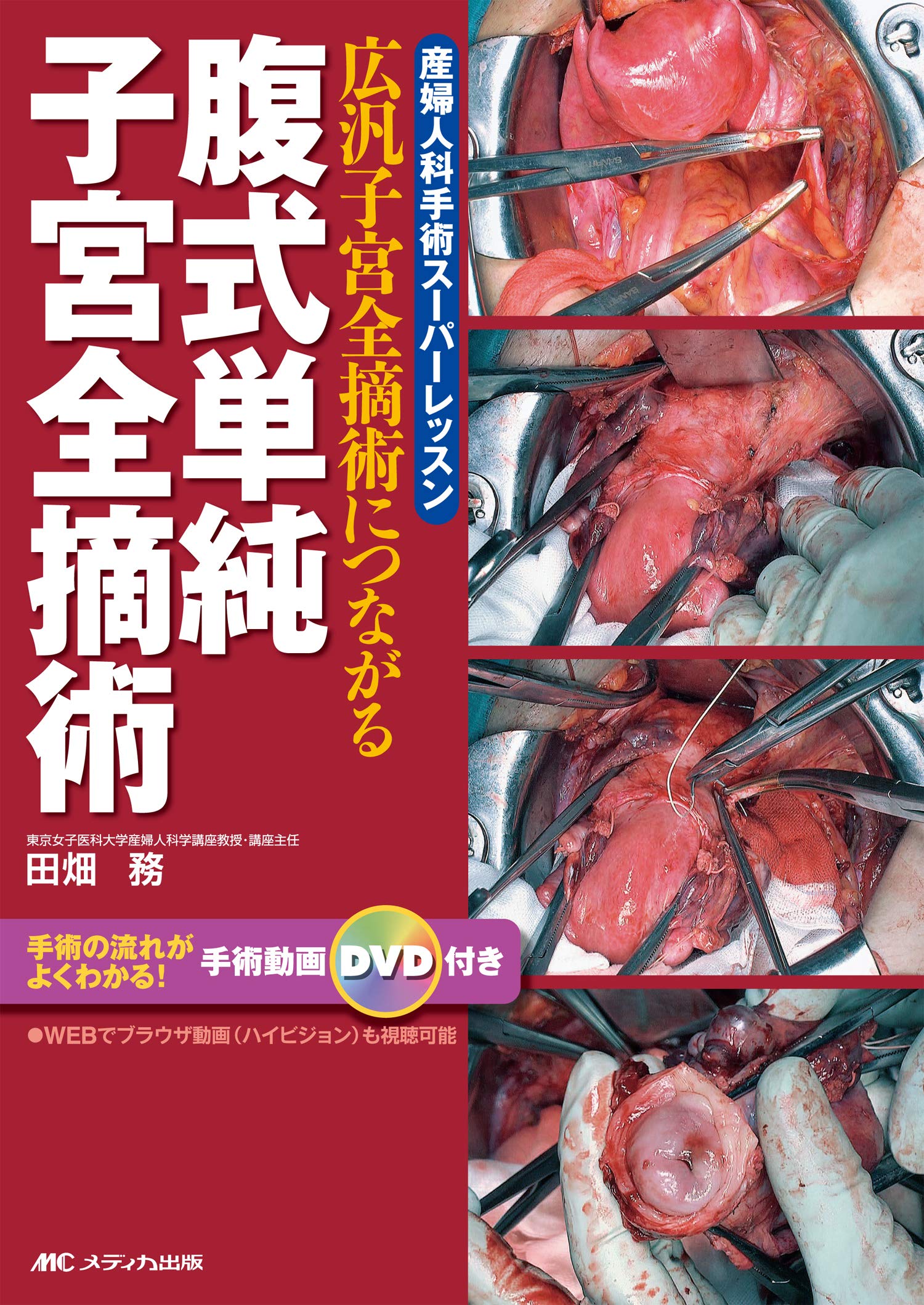 腹式単純子宮全摘術 広汎子宮全摘術につながる 産婦人科手術スーパーレッスン 田畑 務 本 通販 Amazon