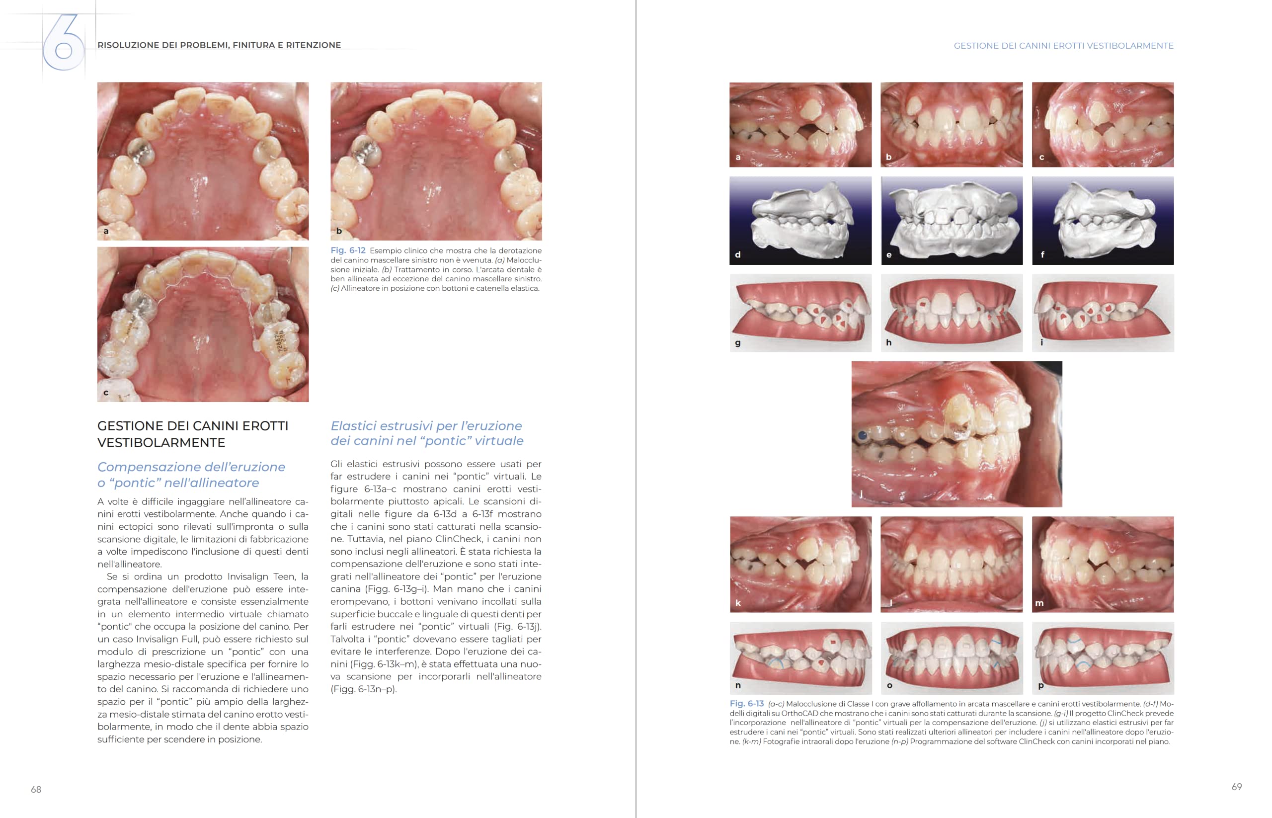 Allineatori trasparenti. Biomeccanica e gestione clinica