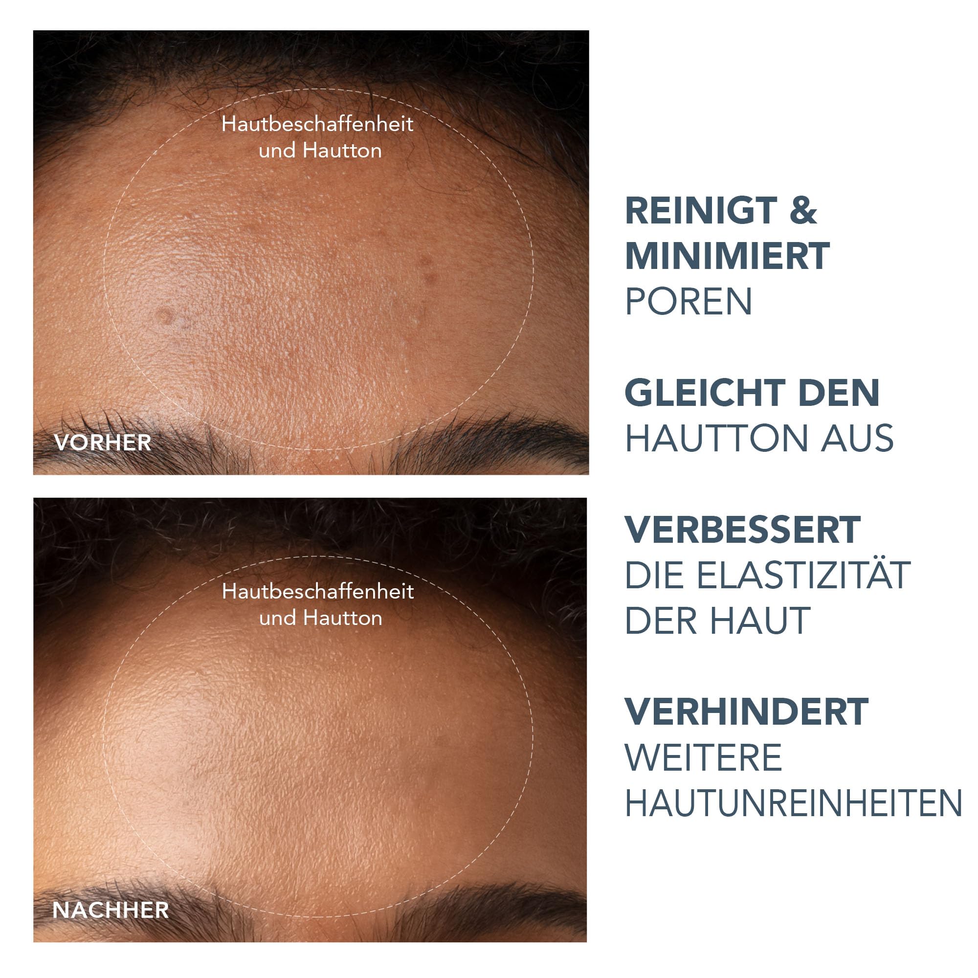 FOREO KIWI Set - Mitesserentferner + Micro-Foam Reiniger 2.0 | Mitesserentferner, Porensauger, Porenverfeinerer, Schaumreiniger, Sauggerät, Schaumreiniger, Alle Haut