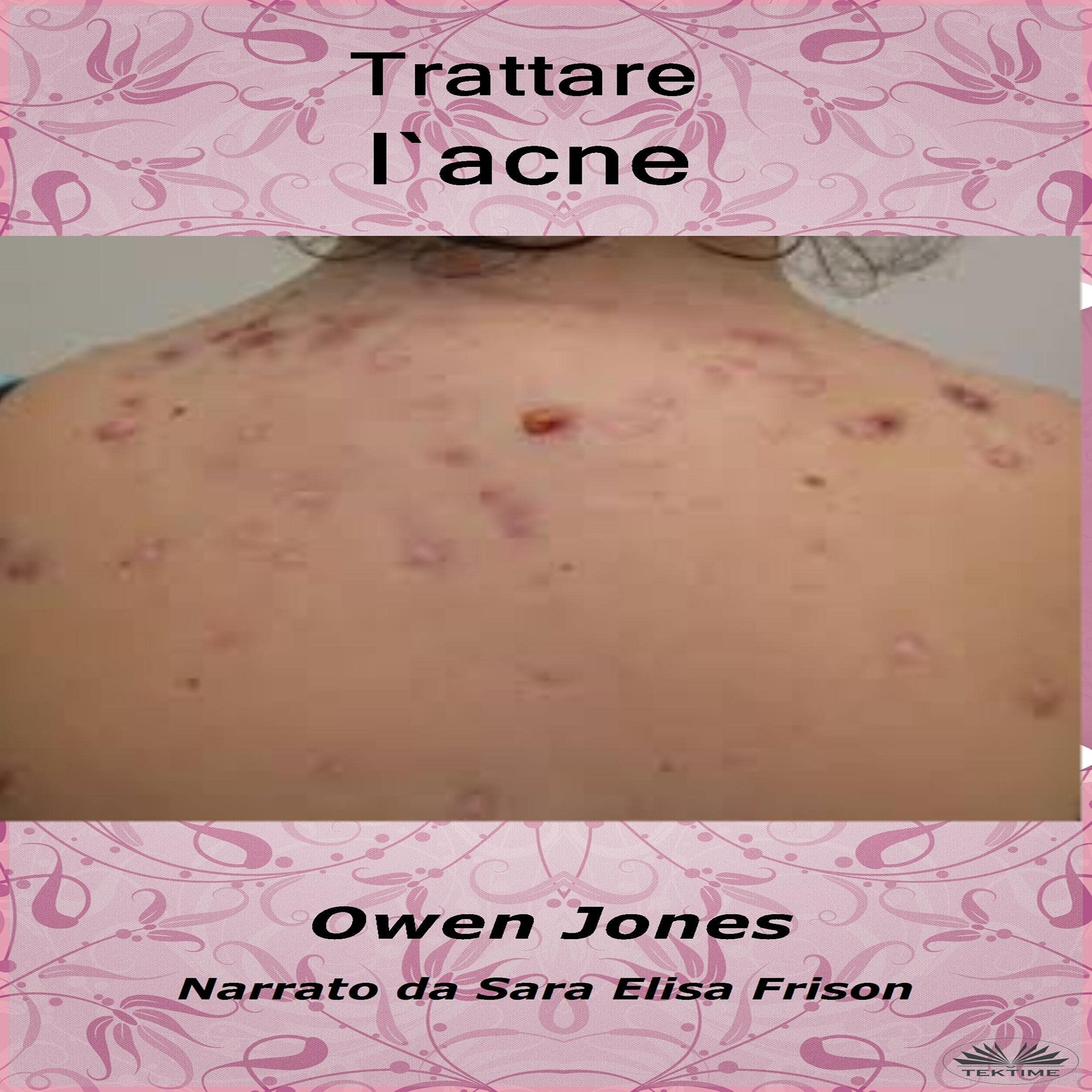 Trattare l`acne [Treat Acne]
