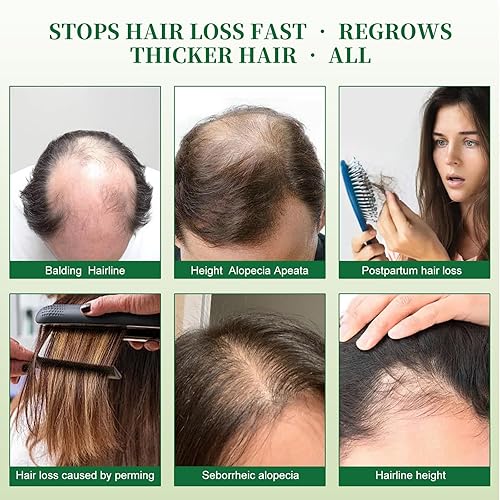 Miniatura 6 de Champú de aceite Batana, champú para el crecimiento del cabello para el adelgazamiento del cabello y tratamiento de pérdida de cabello, romero