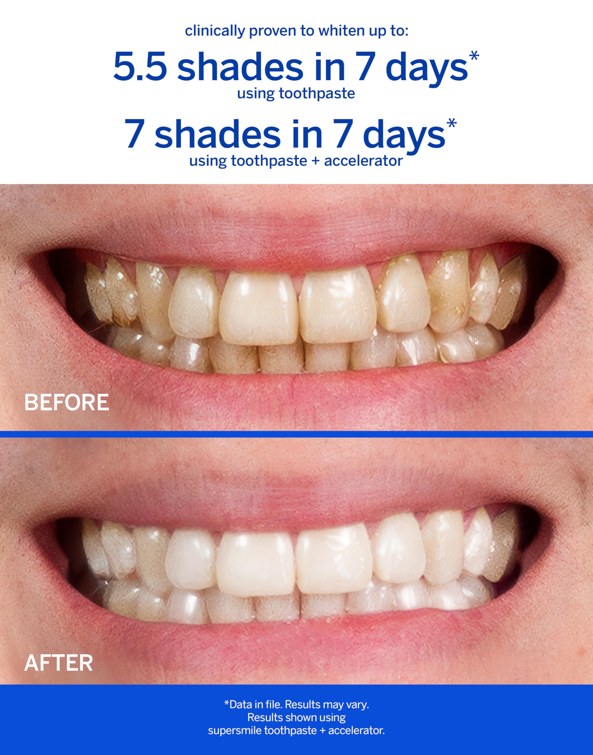 Supersmile Fluoride-Free Whitening System – 1.4oz Professional Grade Whitening Toothpaste & 1.2oz Accelerator – Whitens up to 6 Shades & Strengthens Enamel