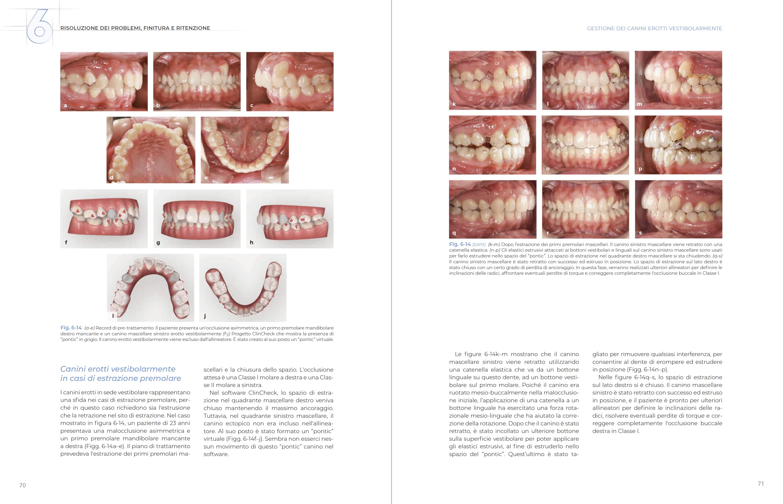 Allineatori trasparenti. Biomeccanica e gestione clinica
