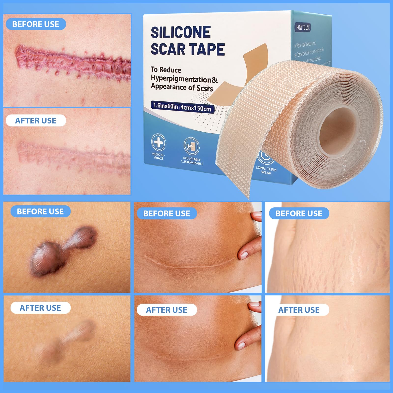 Fogli in silicone per cicatrici (152 x 4,1 cm), rotolo di nastro in silicone per cicatrici, riutilizzabili, trattamento professionale per la rimozione delle cicatrici, per sezione cesareo, chirurgia,