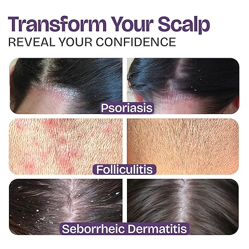 Miniatura 3 de Champú de psoriasis con ácido salicílico - Champú anticaspa para dermatitis seborreica - Tratamiento completo de la psoriasis del cuero cabelludo e