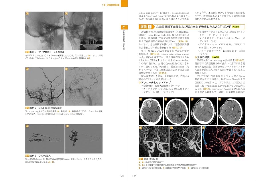 dAVF・AVM(硬膜動静脈瘻・脳動静脈奇形)のすべて : 中枢神経系シャント… dAVF・AVM（硬膜動静脈瘻・脳動静脈奇形）のすべて：中枢神経系