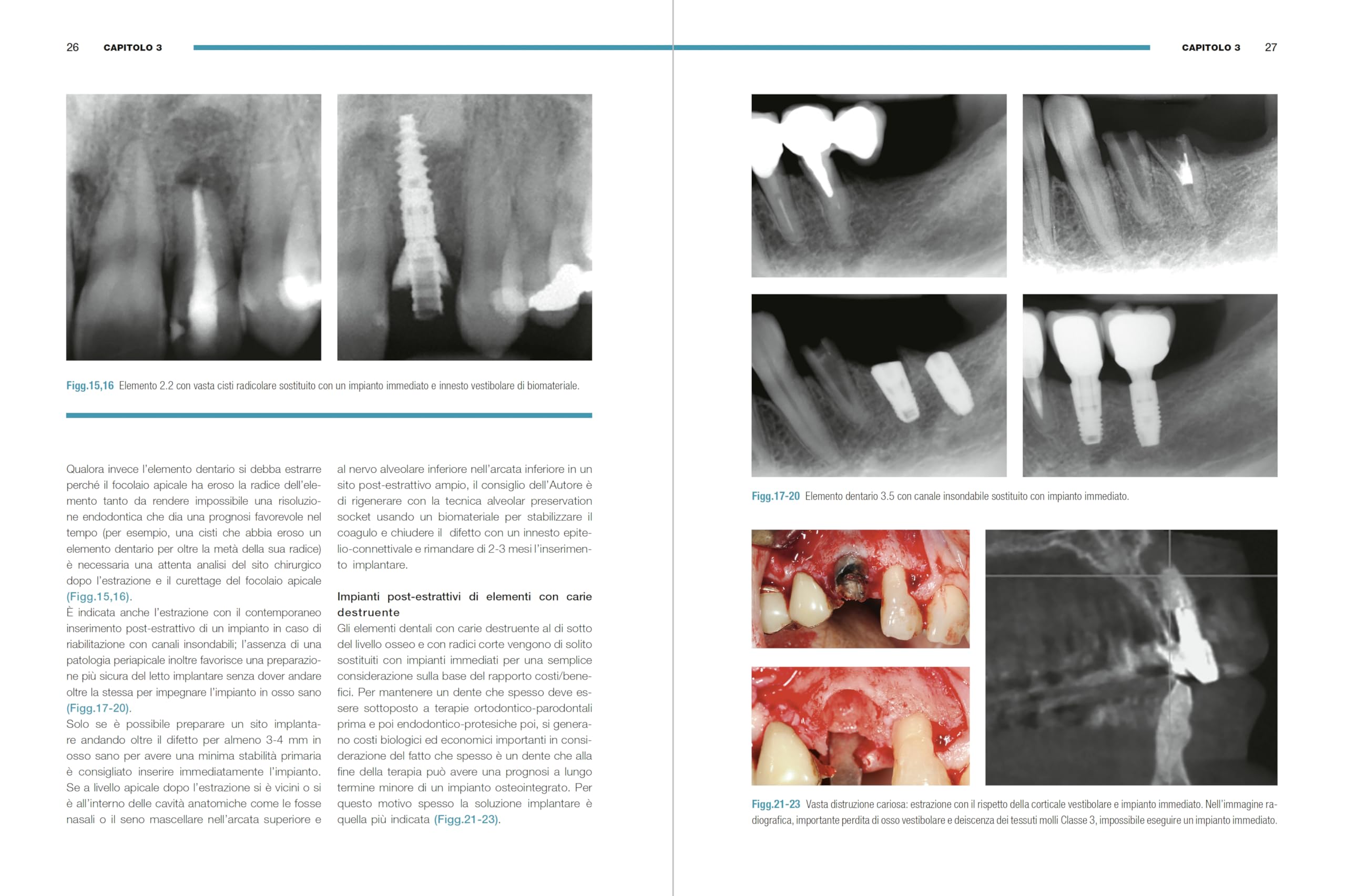 Impianti immediati. Manuale clinico operativo con procedure step by step
