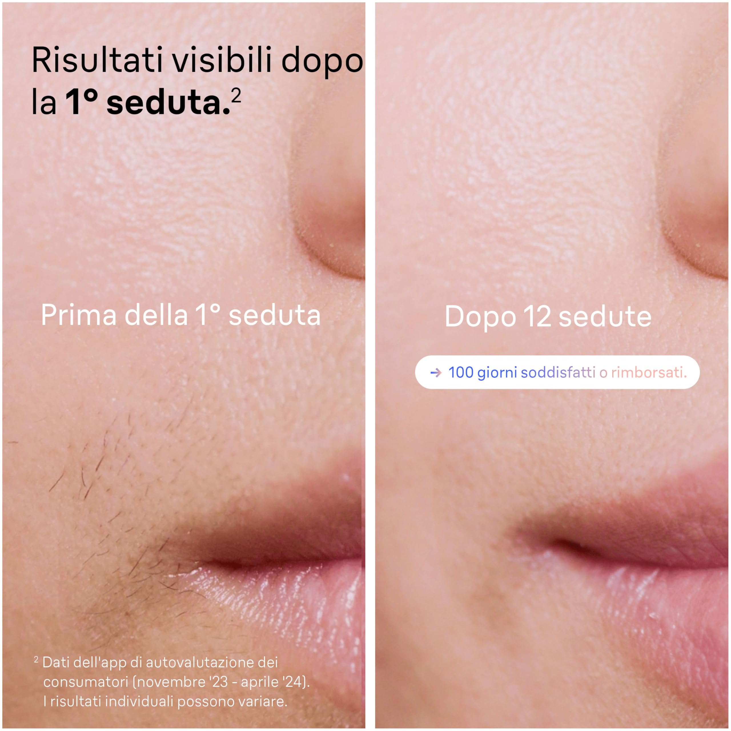 Braun Skin I·Expert Epilatore Luce Pulsata Smart, Depilatore Corpo Donna, Alternativa Laser Peli Donna, App Gratuita, Include Pochette, Rasoio Venus, Luce Pulsata Braun, 4 Testine Viso e Corpo, Pl7387