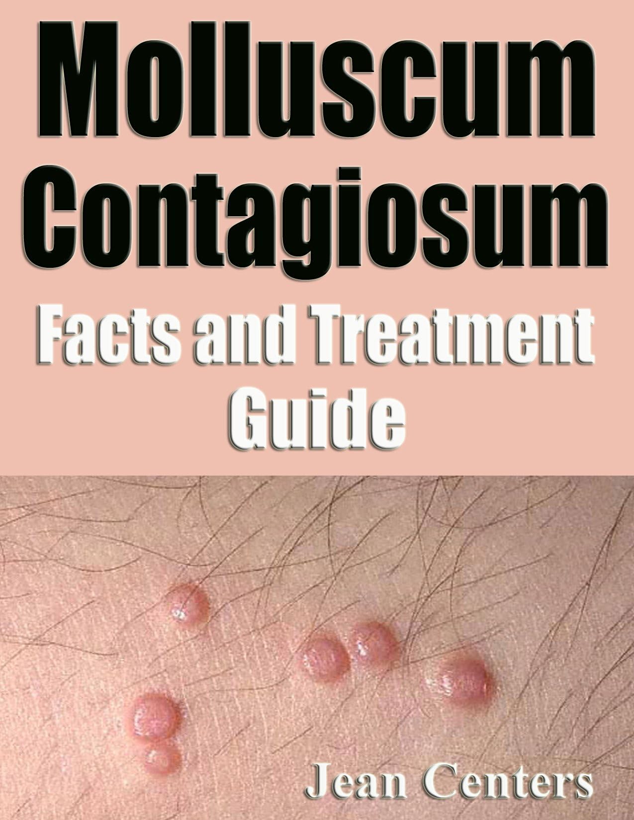 Molluscum Contagiosum Facts And Treatment Guide