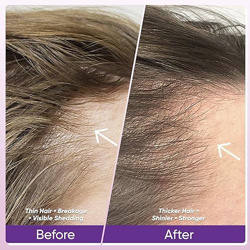 Miniatura 3 de Crecimiento del cabello  Biotina 10,000mcg, colágeno, palma enana enana americana A, C, D3, E, complejo  Regresa naturalmente el cabello, la piel y