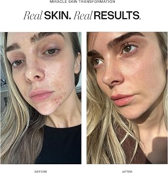Cosmetic Consult Miracle Skin Transformation | Salicylic Acid Face Pads |
