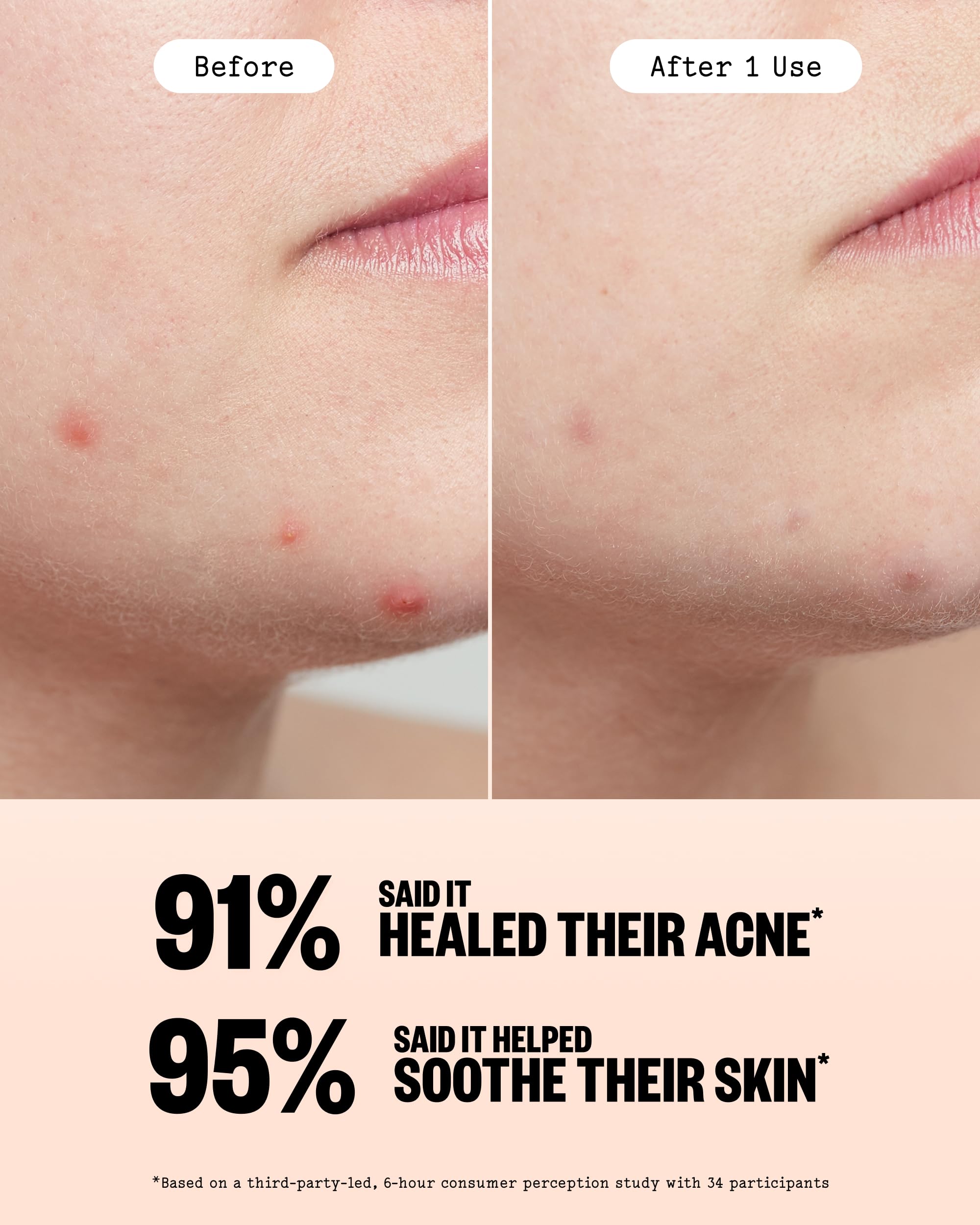 PEACE OUT Parches hidrocoloides para curar el acné, tratamiento de manchas de acné con ácido salicílico, retinol y aloe vera para imperfecciones y brotes (40 unidades)