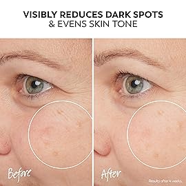 Olay Pro-X Dermatological Even Skin Tone Spot Fading Treatment Serum, 1.3 oz