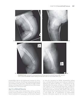 Rockwood and Wilkins' Fractures in Children: Flynn, John M