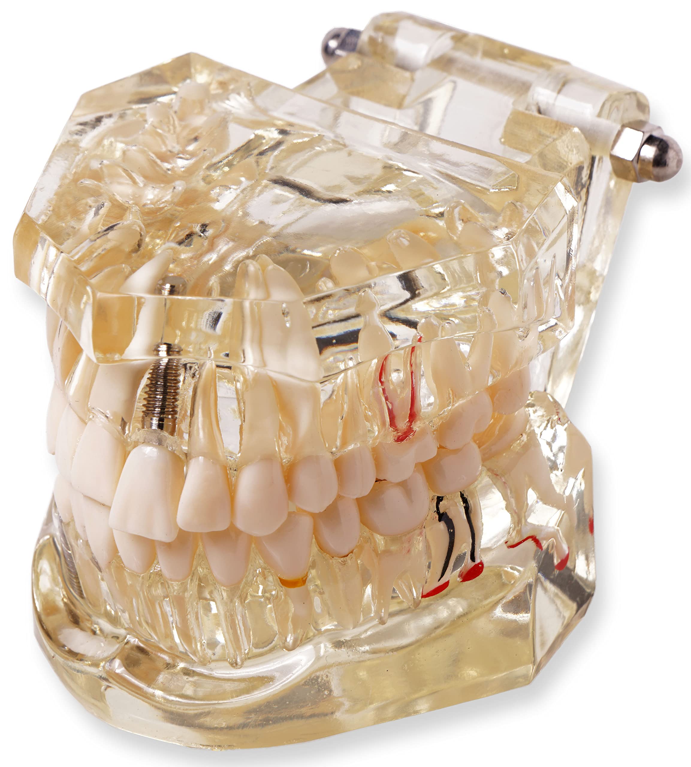 Transparent Dental Model To Demonstrate ✮ Dental Implant ✮ Dental Diseases ✮ Cavities And Other Dental structures and processes ✮ Premium Quality