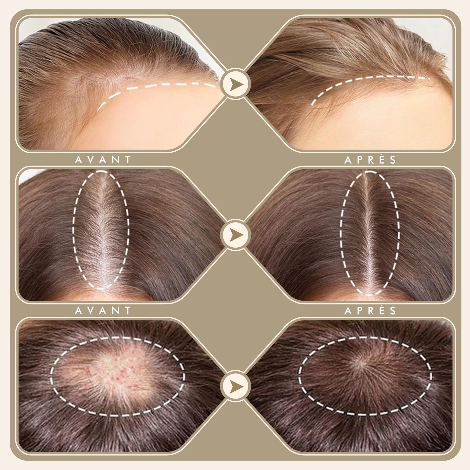Derma Stamp 0-3mm Réglable, 2 in 1 Dermastamp Cheveux avec 64 Micro-aiguilles+120 Micro-aiguilles, Stimuler la Croissance de la Barbe et Des Cheveux pour Cheveux, Barbe, Visage, Corps