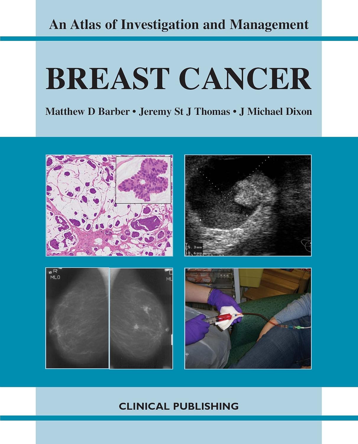 Breast Cancer: An Atlas of Investigation and Management: 9781904392958 ...