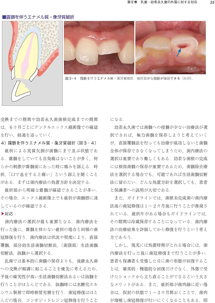 これで安心！ 乳歯・幼弱永久歯の外傷への対応―保存か抜歯かを見極め