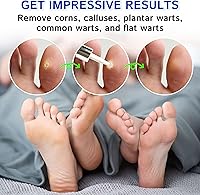 Vista 6 de Ulensy Removedor de Callos Líquido para Dedos de los Pies 20ml de Ácido Salicílico para Callos de los Pies, Eliminación de Verrugas en el Trabajo
