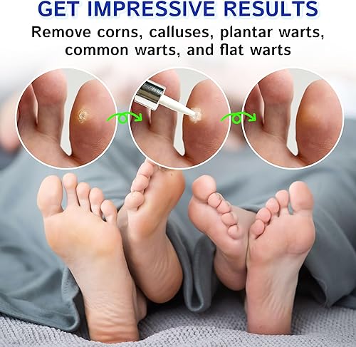 Miniatura 6 de Ulensy Removedor de Callos Líquido para Dedos de los Pies 20ml de Ácido Salicílico para Callos de los Pies, Eliminación de Verrugas en el Trabajo y