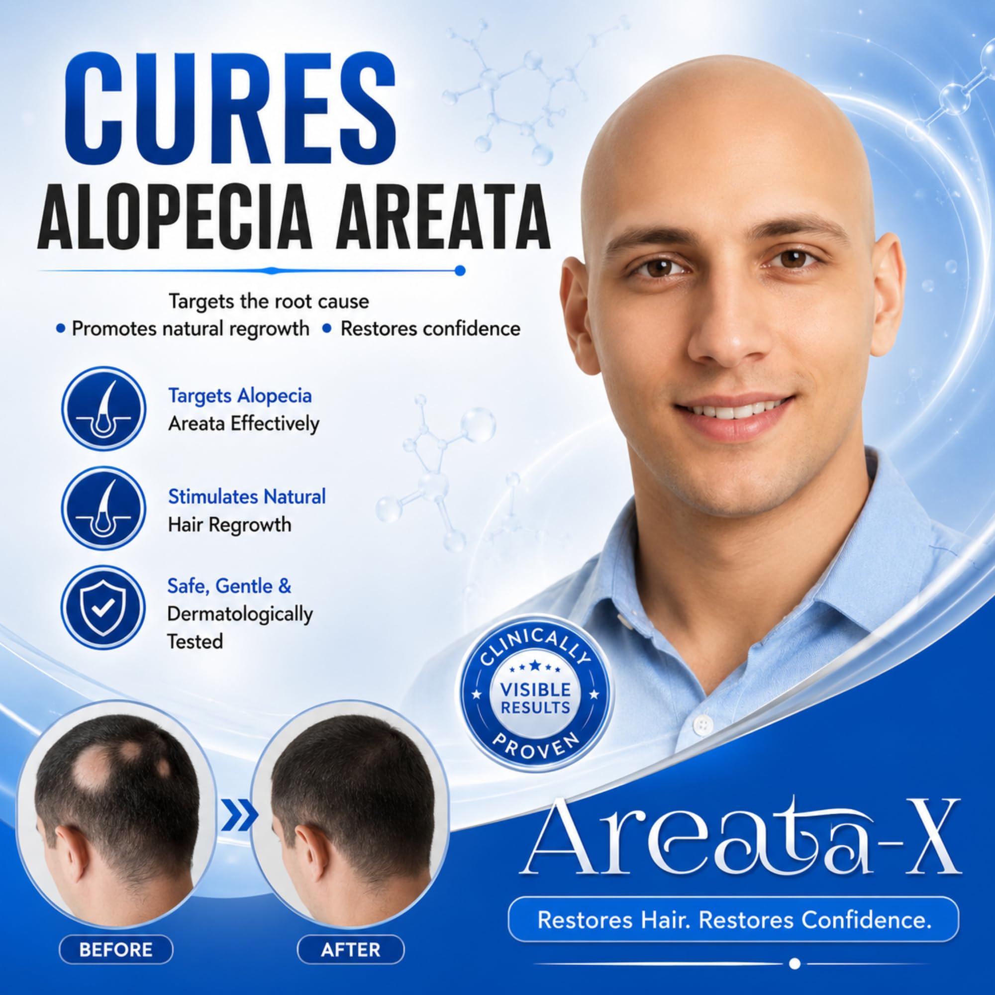 Global Pharma Alopecia Areata-X Hair Lotion Hair Care Solution for Bald Patches and Thinning 4