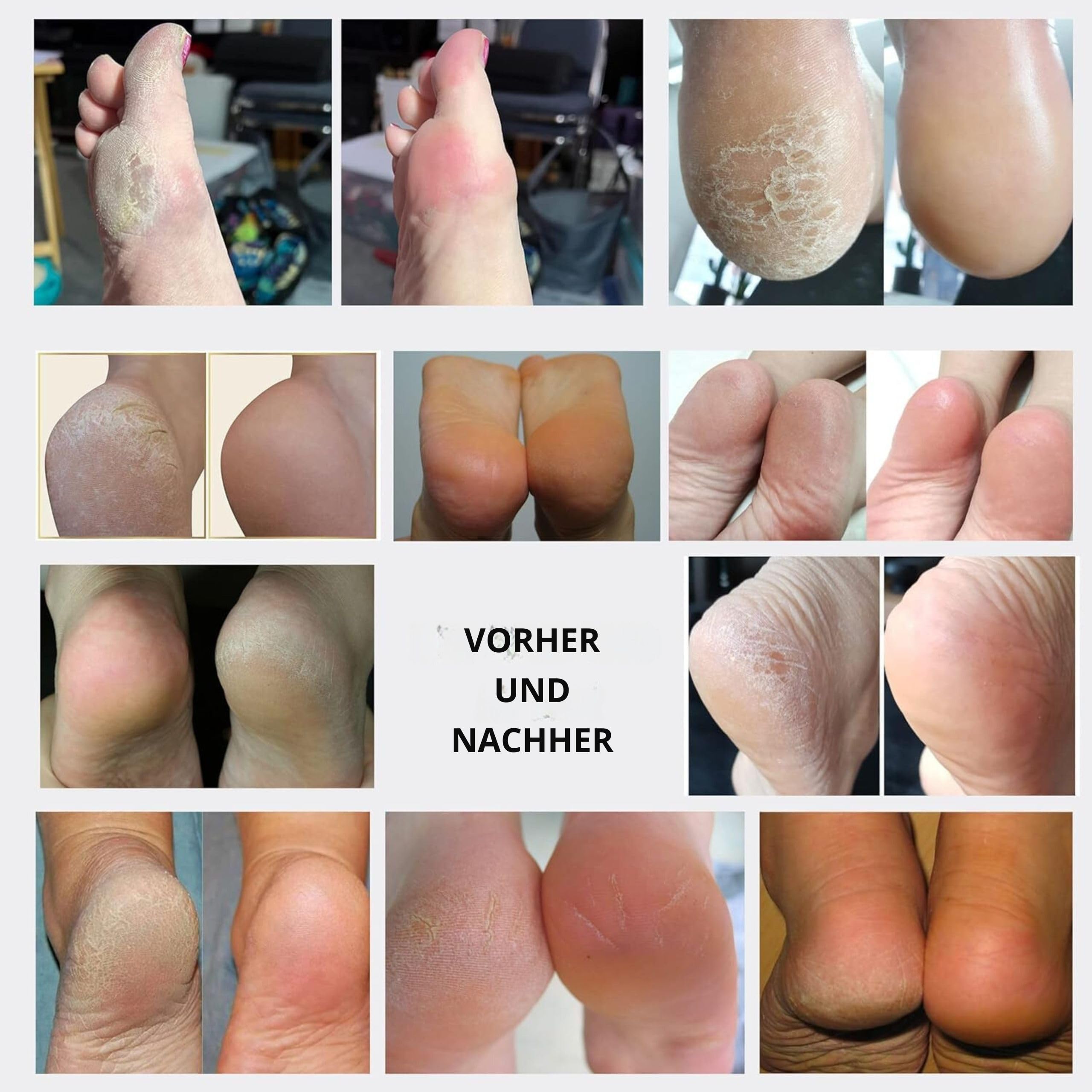 Hornhautentferner, Sofortiges Peeling-Spray für die Füße, Weichmacher für rissige Fersen und abgestorbene Haut, Pediküre-Behandlung kompatibel mit jeder Fußfeile. Wonder Pedi (200 ml)