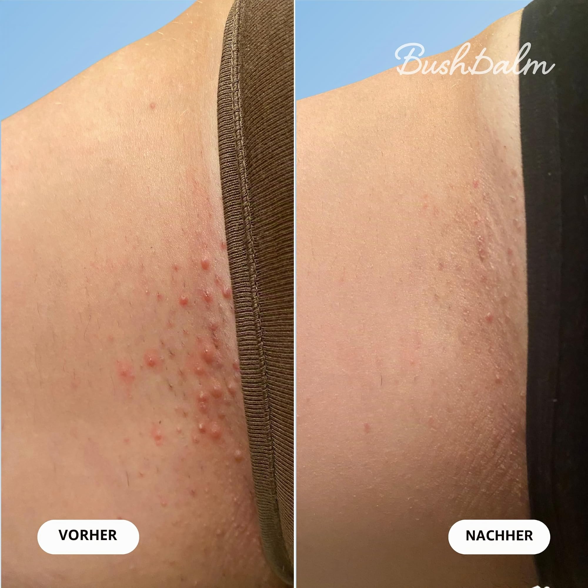 Bushbalm Nude eingewachsenes Haaröl – hilft bei Achselbeulen, beruhigt Rötungen nach der Rasur, 30 ml
