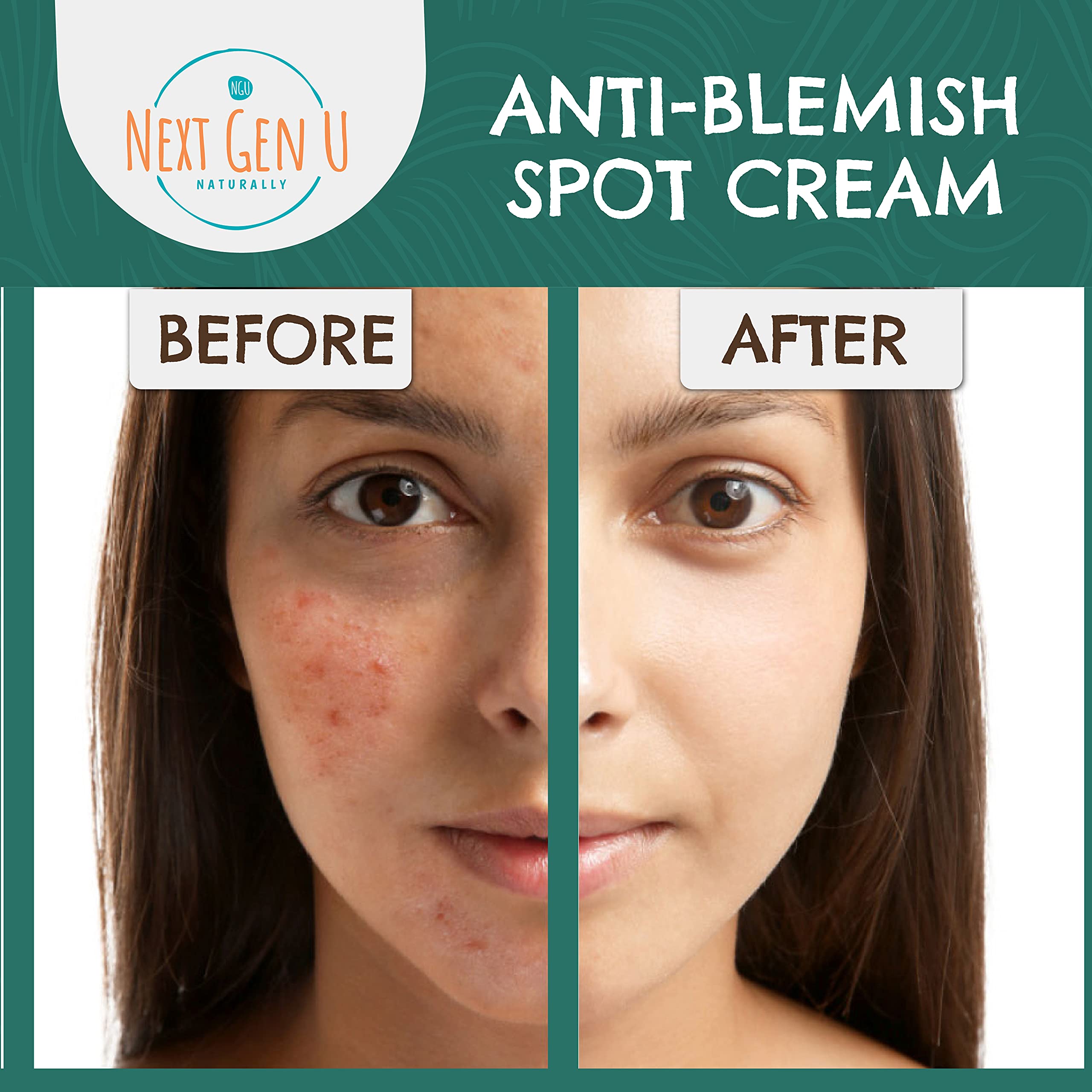 AntiBlemish Spot Cream 100ml Helps Reduce Blackheads & Blemishes