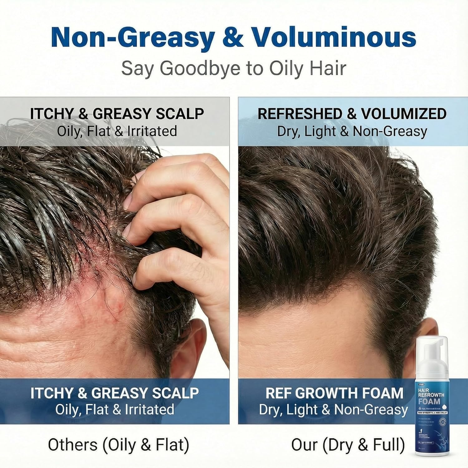 5% Minoxidil Foam for Men, Fast-Absorbing Non-Greasy Hair Regrowth Treatment for Thinning Hair & Beard, Get Stronger Thicker Fuller Hair, Clinically Proven, 2 x 2.11 Oz (2 Month Supply)