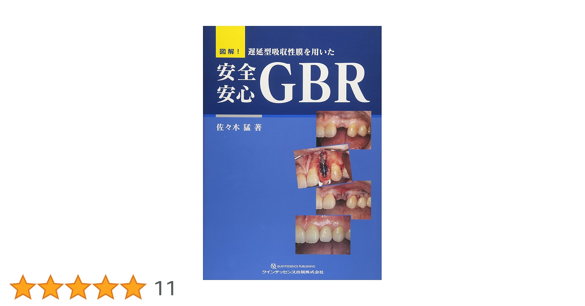 Amazon.co.jp: 図解! 遅延型吸収性膜を用いた 安全安心GBR