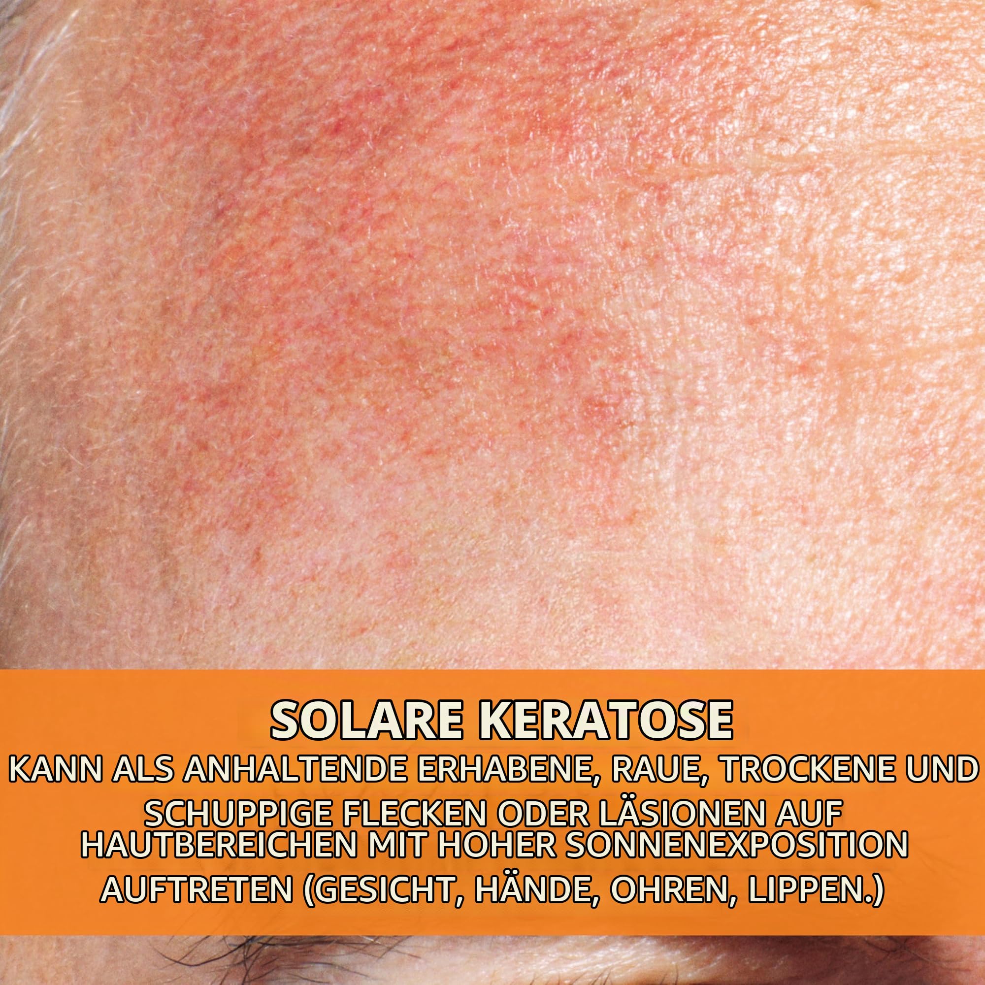 La Roche Posay Anthelios KA+ MED Creme, Hochwirksame medizinische Sonnencreme, Zur Prävention von aktinischer Keratose (AK) und nicht-melanozytärem Hautkrebs (NMSC), Sehr hoher Breitband-Schutz, 50 ml