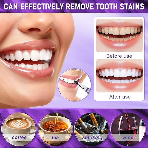 Penna Sbiancante Denti, Teeth Whitening Pen, Schiarimento Rapido Macchie Superficiali, Semplice & Conveniente, Schiarisce Macchie Da Caffè E Tè, Per Uso Domestico E In Viaggio - 3
