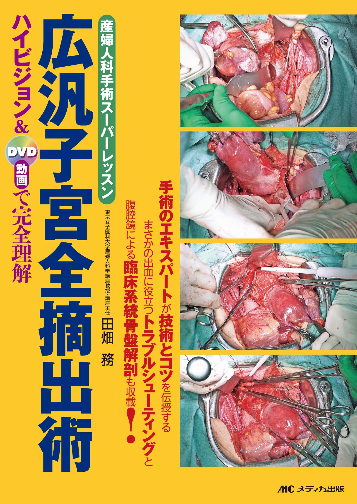 広汎子宮全摘出術 産婦人科手術スーパーレッスン ハイビジョン Dvd動画で完全理解 田畑 務 配送料無料
