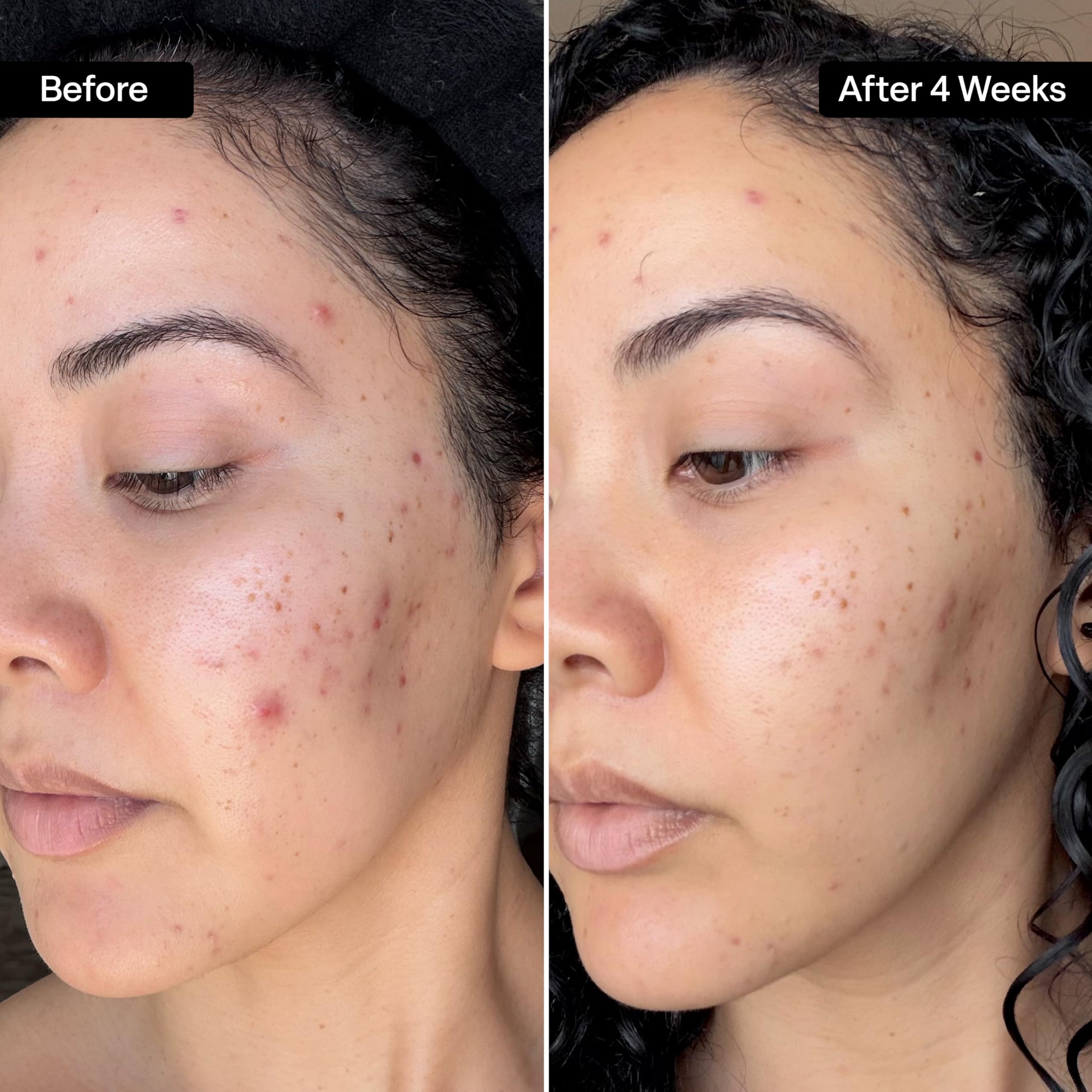 QRxLabs Dischi di Resurfacing Dermal al al 20% di Acido Glicolico - Vitamine B5, C ed E, Tè Verde, Calendula, Allantoina - Esfolia la Pelle di Superficie e riduce le rughe e le riduzioni