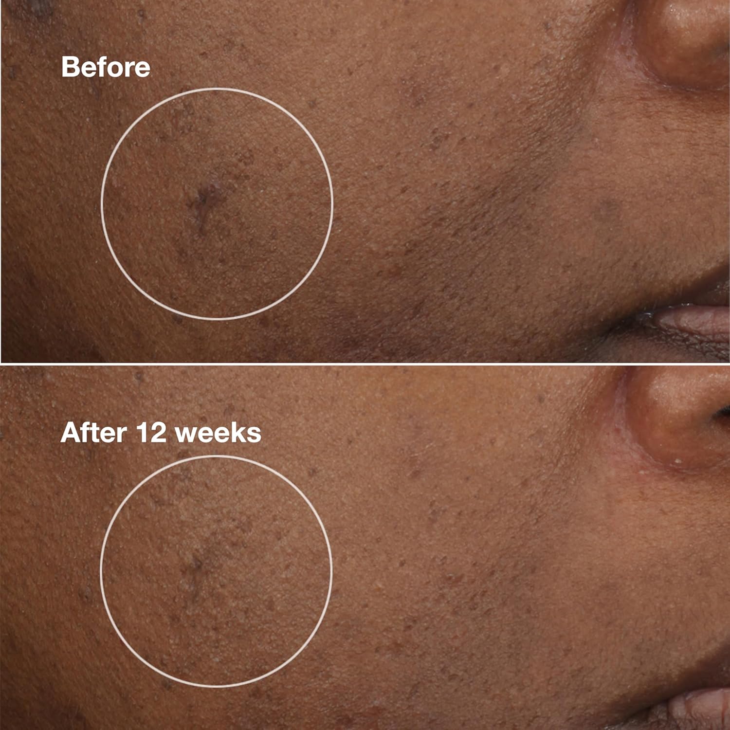 Clinique Even Better Clinical Brightening Moisturizer With Salicylic Acid, Glucosamine + Vitamin C | Hydrating + Dark Spot Reducing - Image 4