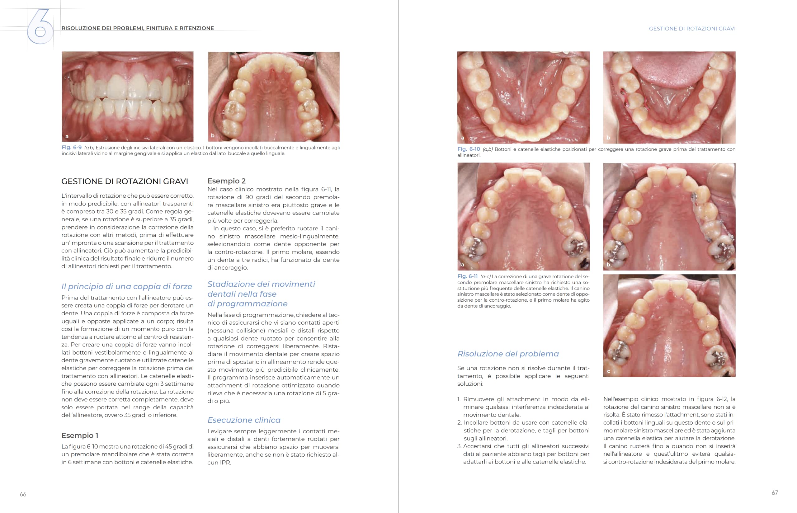 Allineatori trasparenti. Biomeccanica e gestione clinica
