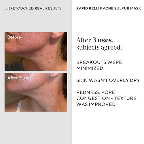 Miniatura 5 de Murad Máscara de azufre para acné de alivio rápido, mascarilla facial de arcilla para control del acné con ácido salicílico, 2.5 onzas líquidas