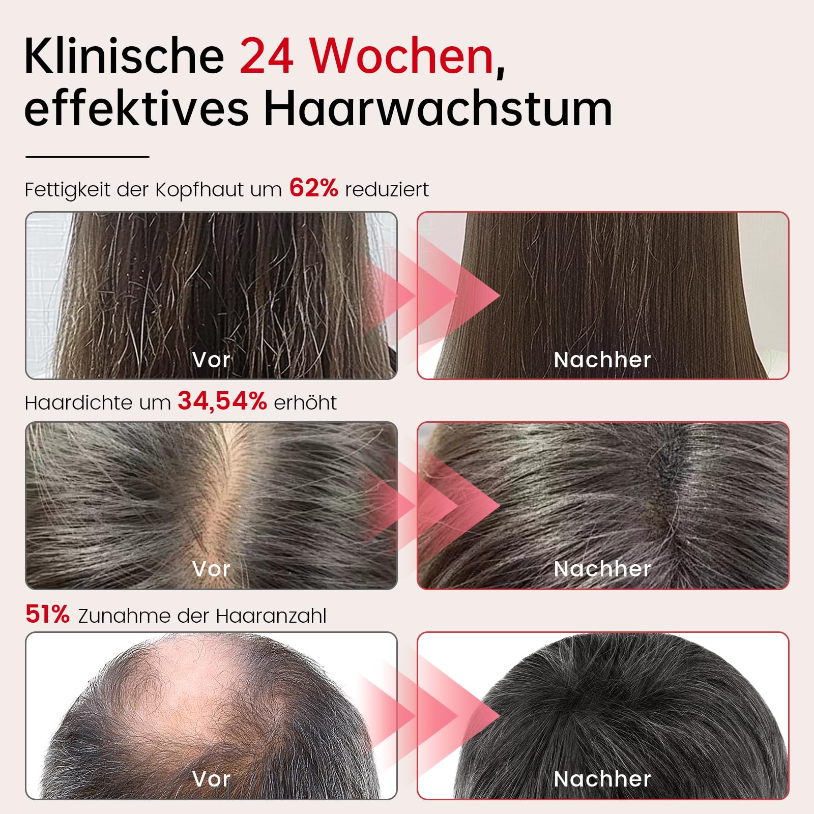 Laser Haarwachstum Cap für Haarwachstum Beschleunigen, 238 Laser und LED-Lampenperlen, 665nm Laser + 660nm Rotlicht+ 850nm Infrarotlicht, Haarfollikelaktivität zu steigern und Haarausfall vorzubeugen