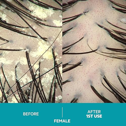 Miniatura 5 de DS Laboratories - Champú para caspa de caspa para picazón cuero cabelludo seco champú para psoriasis champú para dermatitis seborreica para hombres