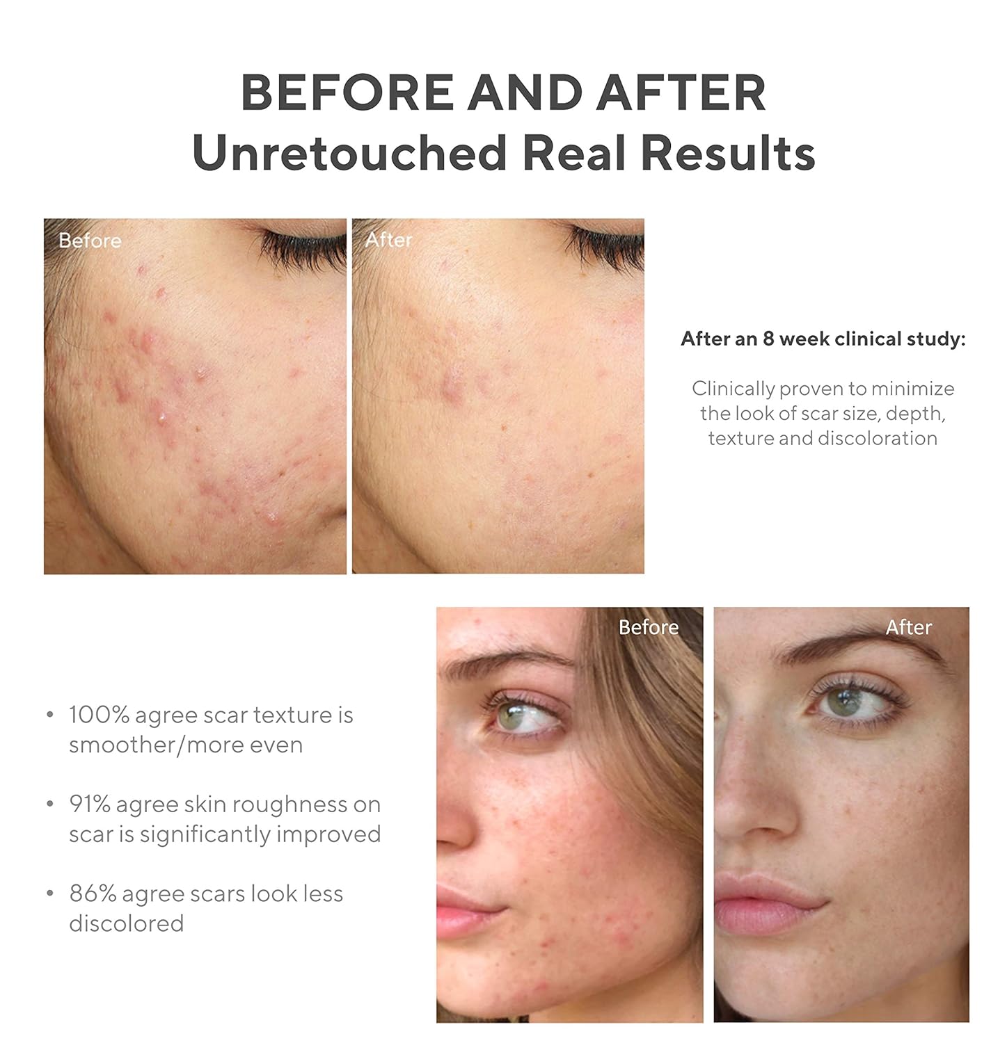Buy Murad InvisiScar Resurfacing Treatment for reducing the appearance