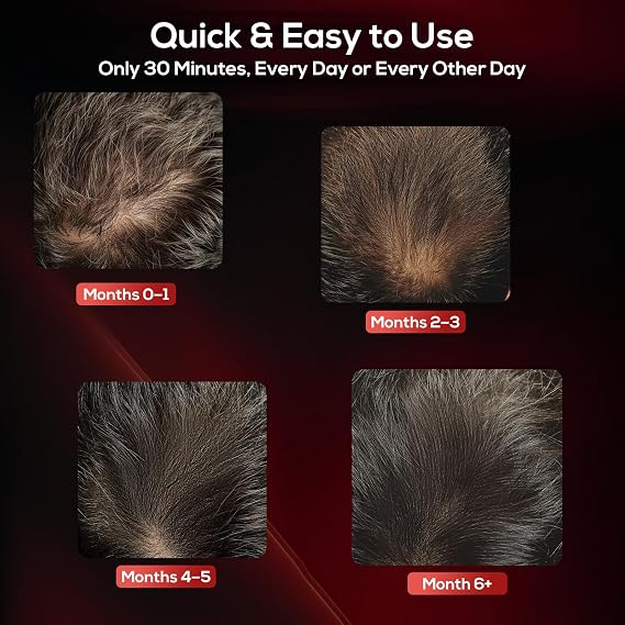 Laser Hair Growth Cap, Low Level Laser Therapy (LLLT) Device Designed to Promote Hair Growth in Women and Men,Laser Cap